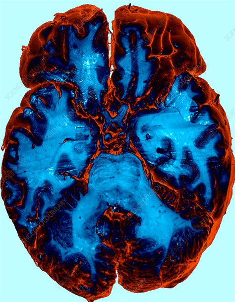 Enhanced Cadaver Brain Section Stock Image C0365171 Science
