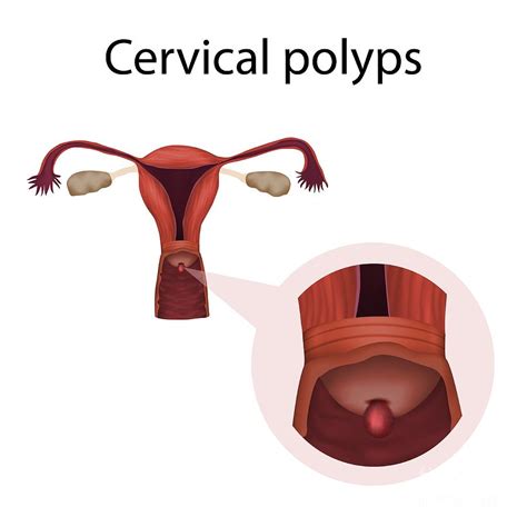 Cervical Polyps Photograph By Veronika Zakharovascience Photo Library