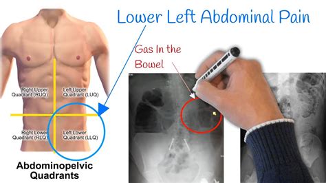 Pain In Lower Left Abdomen Low Stomach Pain Most Common Causes YouTube