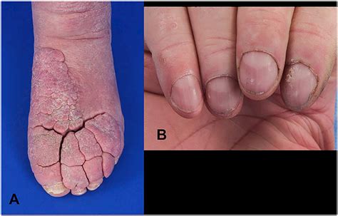 Rheumatologic And Imaging Manifestations Of Thyroid Acropachy