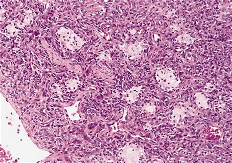 Pathology Outlines Deep Fibrous Histiocytoma