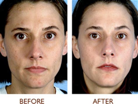 Serum is a skincare product you can apply to your skin after cleansing but before moisturizing with the intent of delivering powerful ingredients directly into the is serum a moisturizer? Personal MicroDerm System - For Mom