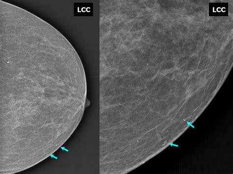 Atlas Of Breast Cancer Early Detection