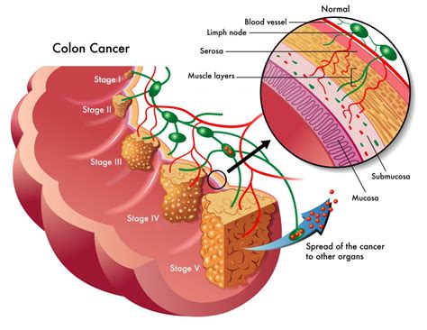 What Are The Symptoms Of Colorectal Cancer In Men
