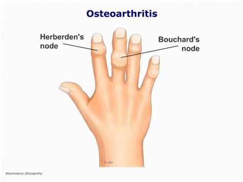 Osteoarthritis Of The Fingers Hanp03 Bloomsbury Health Centre
