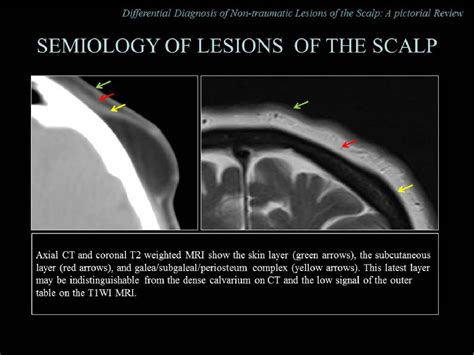 Differential Diagnosis Of Non Traumatic Lesions Of The Scalp A