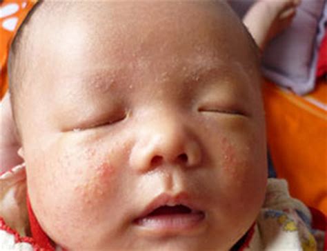 新生儿湿疹宝宝脸部图片有来医生