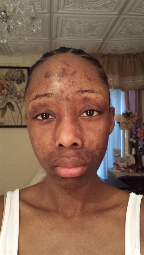 Black Peoples Reaction To Bp Help General Acne Discussion Acne