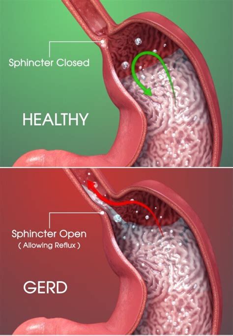 How Many Esophageal Cancer Patients Had Untreated GERD? » Scary Symptoms