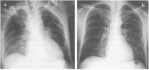 Figure 1 From A Case Of Acute Fulminating Beriberi Leading To Cardiac