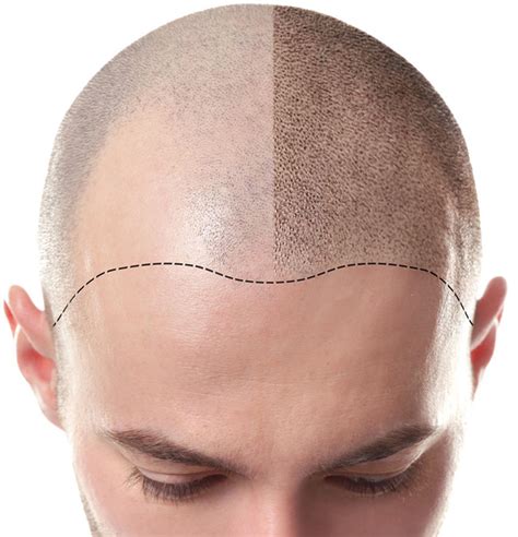 Scalp Micropigmentation Natural Looking Alternative For Hair Restoration