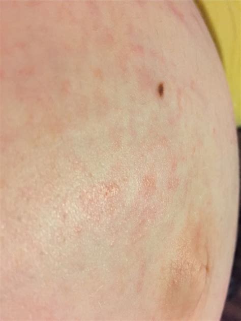 Itchy Rash On Pregnant Belly Blackmores Pregnancy