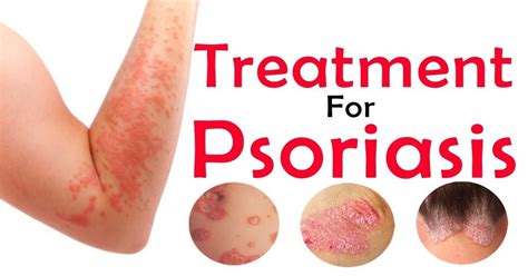A New Breed Of Psoriasis Treatments Ere Aec