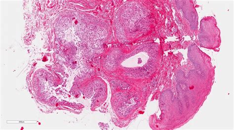 Mucous Retention Cyst Lip Pathology Outlines
