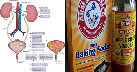how to treat urinary tract infection with apple cider vinegar and baking soda