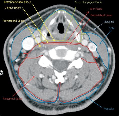 Nontraumatic Head And Neck Emergencies Radiographics