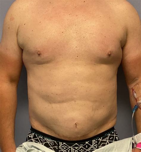 Plastic Surgery Case Study Six Pack Ab Implants In The Male Tummy