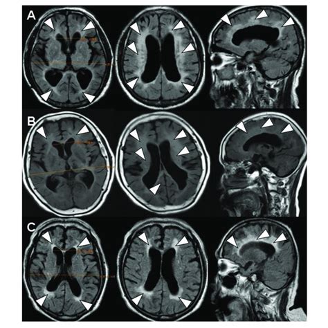 The Brain Flair Mr Imaging Flair Mri Demonstrated The Similar Image