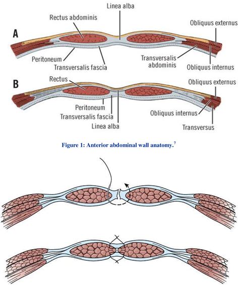 Figure 1 From A Prospective Study Of Single Layer Abdominal Wall
