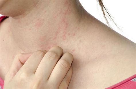 Scabies Vs Eczema Differences Causes And Treatment
