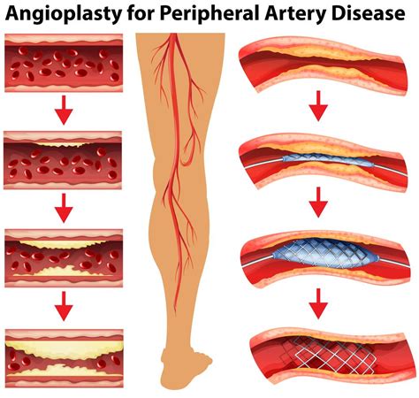 Diagram Showing Angioplasty For Peripheral Artery Disease 295177 Vector