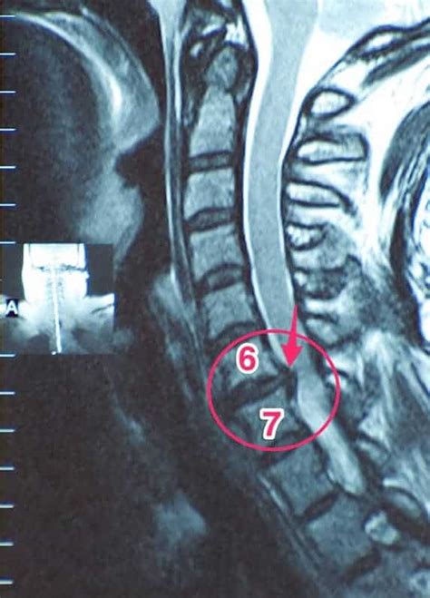 Mom Experiencing Life Again With Cervical Disc Arthroplasty