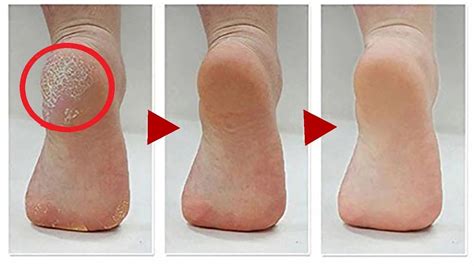 How To Get Rid Of Calluses On Feet 6 Natural Home Remedies To Get Rid