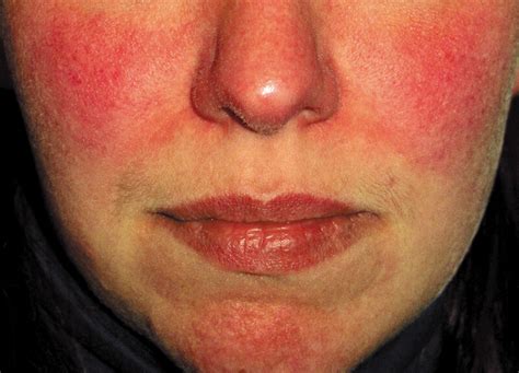 New Publication Updates Physicians On Facial Redness In Rosacea