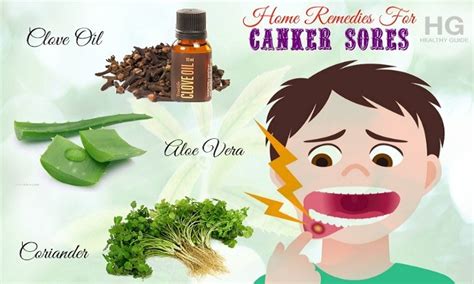 20 Home Remedies For Canker Sores On Tongue Gums And In Throat