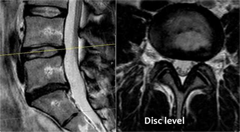 Lumbar Spine Mri Bulging Disc