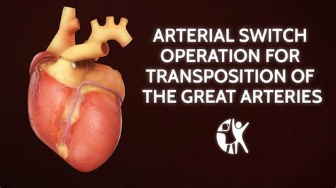 Arterial Switch Operation For Transposition Of The Great Arteries