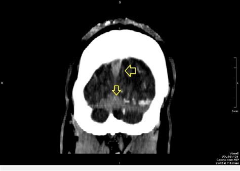 Coronal View On Contrast Ct Scan Showing Superior Sagittal Sinus