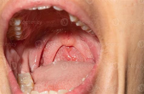Sore Throat With Throat Swollen Closeup Open Mouth With Posterior Pharyngeal Wall Swelling And