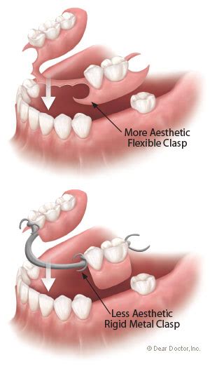Flexible Partial Dentures Biermann Orthodontics