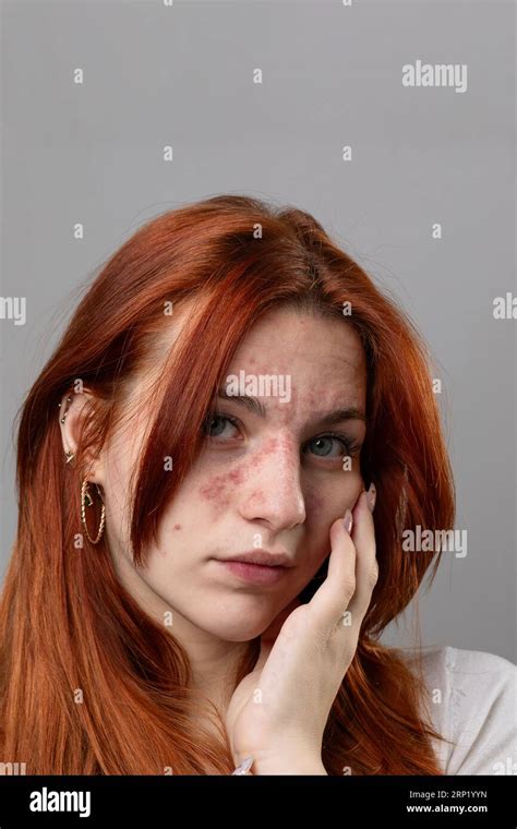 Young Woman With Acute Skin Rash On Her Face Dermatological Problems