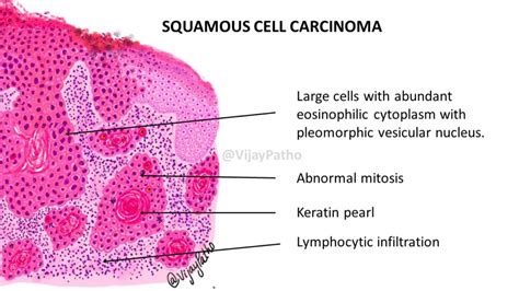 Pathology Of Squamous Cell Carcinoma Pathology Made Simple