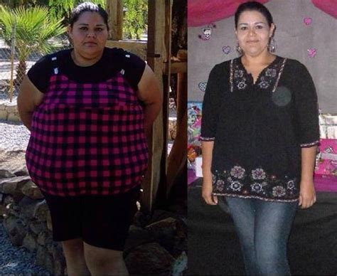 weight loss tijuana mexico tijuana bariatrics