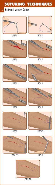 Complete Guide To Mastering Suturing Techniques Emergency Medicine