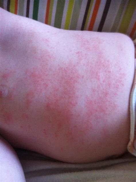 Baby Egg Allergy Rash Pictures Divina Cleary