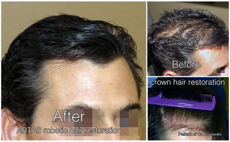 Check spelling or type a new query. Hair Transplant - Before and After Pictures | Hair ...