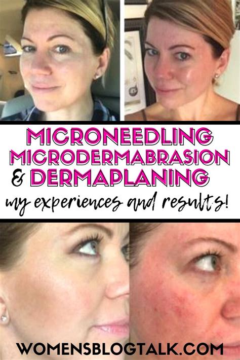 Microneedling Microdermabrasion And Dermaplaning Results And Before