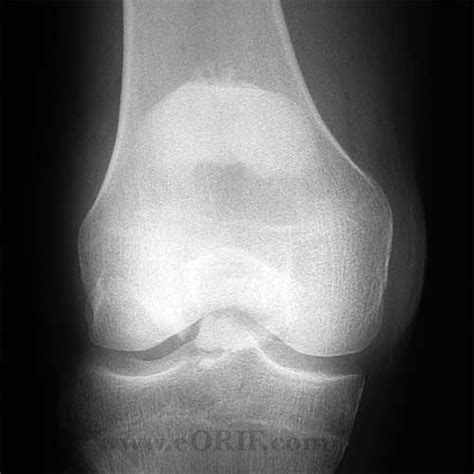 Patella Fracture S82.009A 822.0 | eORIF