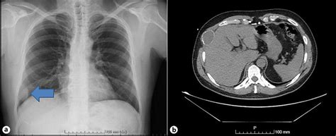 A Chest X Ray Showed A Lytic Lesion Of The Rib Cage Blue Arrow B