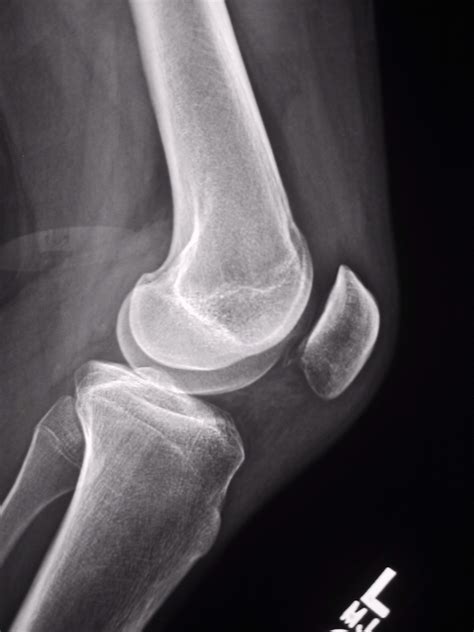 Knee Injuries Knee Injuries X Rays