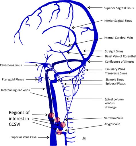 Frontiers Endovascular Therapy For Chronic Cerebrospinal Venous