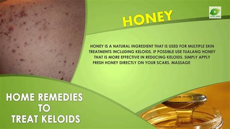 Home Remedies To Treat Keloids Best Health Tips Educational Videos