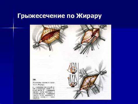 Диета при грыжи диафрагмы НАРУЖНЫЕ ГРЫЖИ ЖИВОТА Паховый канал Передняя НАРУЖНЫЕ ГРЫЖИ ЖИВОТА Паховый канал Передняя Диета при грыжи диафрагмы