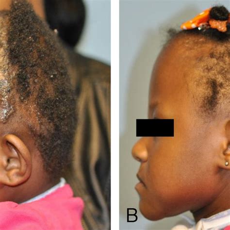 Pdf Posterior Cranial Vault Distraction In The Treatment Of Shunt