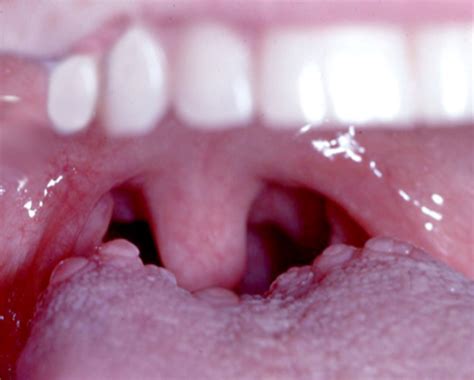 Bumps On Back Of Tongue Bumps On Back Of Tongue Common Causes And Home