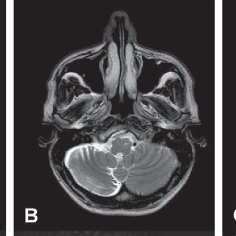 Mri Of The Brain Axial T2 Weighted Ffe Image At The Level Of The Bulb